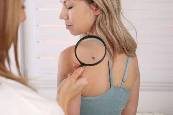 What Are Traditional Skin Lesion Removal Methods Milngavie?