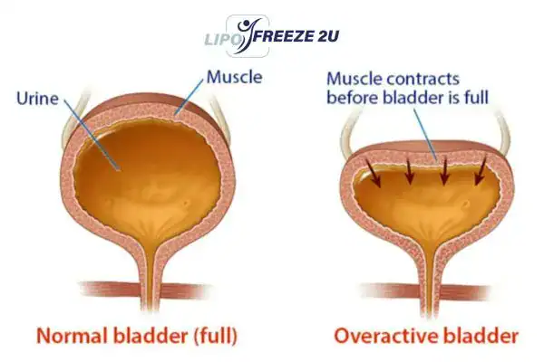 diagram of overactive bladder treatment Milngavie
