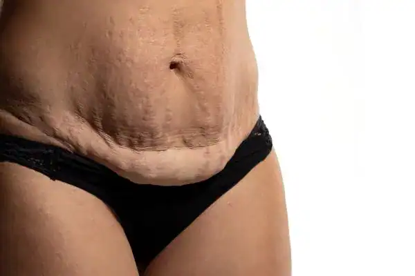 loose skin after weight loss injections Milngavie
