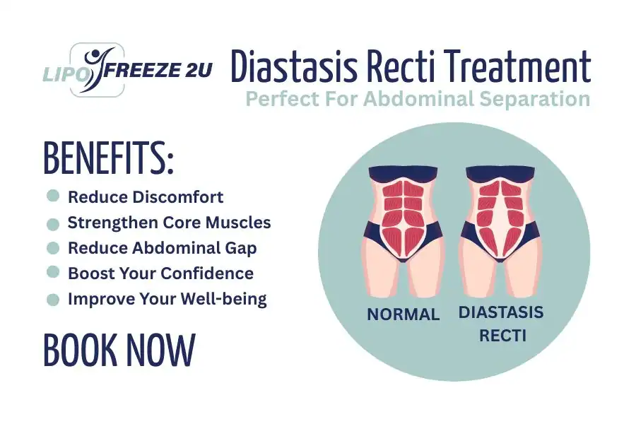 Benefits of body toning treatment Milngavie for Diastasis recti