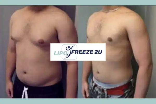 How Long Does It Take to See Results Milngavie?