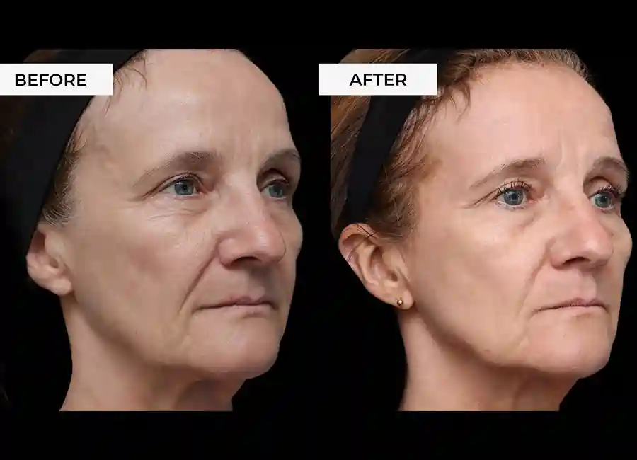 How Many RF Microneedling Sessions Will You Need to See a Difference Milngavie?
